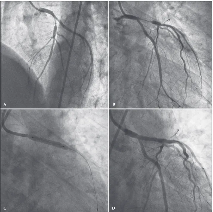 Figure 2 – Treatment of in-stent restenosis. (A and B) Diffuse in-stent restenosis in the ostium and proximal portion of the left anterior descending  artery