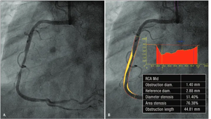 Figure 2 – Quantitative coronary angiography (A and B). Quantitative coronary angiography of the lesion in the middle third of the right coronary  artery, conirming the presence of a moderate stenosis