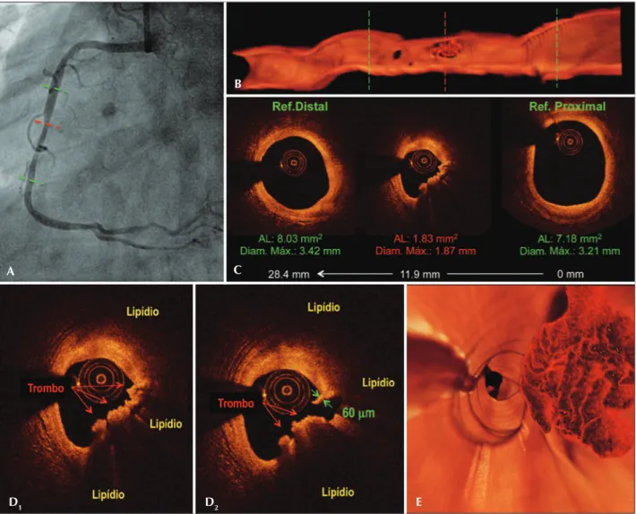 Figure 3 – Pre-procedure. Angiography of the right coronary artery (A). Longitudinal section of three-dimensional reconstruction of images obtained  with optical coherence tomography