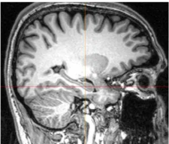 Figure 1.  Three-dimensional T1-weighted images with high  spatial resolution and good white matter/grey matter contrast  are necessary for the analysis of cortical thickness.