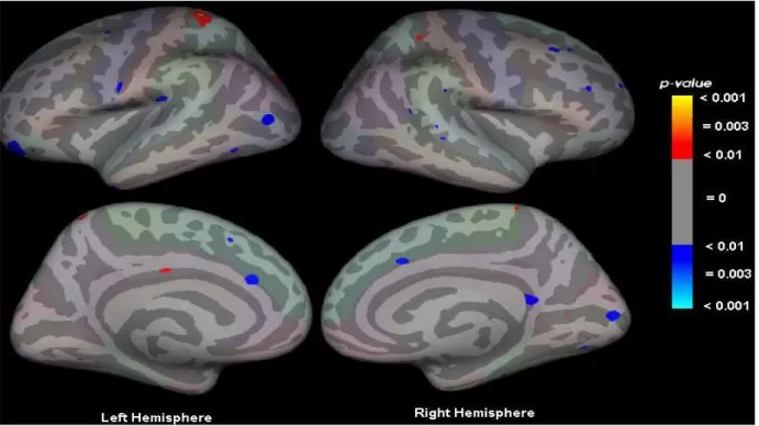 Figure 2 shows the statistical maps of significant  differences  in  cortical  thickness  between  patients  with  bipolar  disorder  compared  with  controls