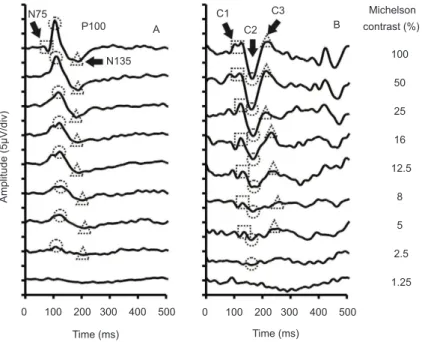 Figure 1. Recordings obtained from one subject using two stimulation modes. (A) Pattern-reversal stimulation elicited transient  VEPs with three main components: N75 (square), P100 (circle), and N135 (triangle)