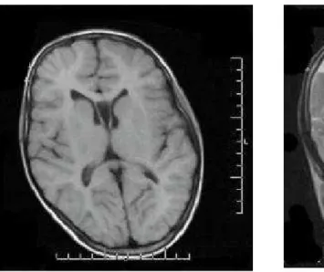 TABLE 4. Scores obtained in the monotic tests of the auditory processing and its respective patterns of normality.