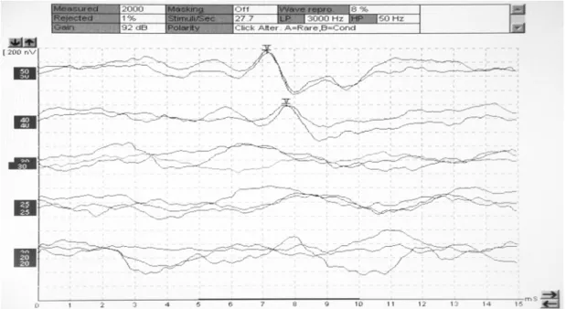 FIGURE 1. Electrophysiological threshold,  ipsilateral recording, obtained in a female subject, with the vibrator positioned on the forehead.