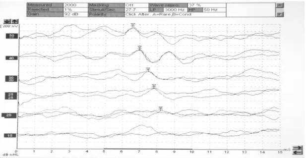 FIGURE 2. Electrophysiological threshold,  ipsilateral recording, obtained in a female subject, with the vibrator positioned on the mastoid.