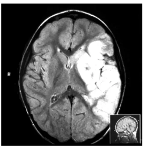 FIGURE 1. MR- Commitment of the left cerebral parenquimal the territory of the MCA. 020406080100  DD DD SSW SSW RELE FIGURE 2