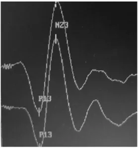 FIGURE 1. Line traced by VEMP recording: formation of biphasic P13 and N23 potential.  