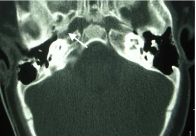 FIGURE 1. CT of temporal bone showing EVA to the right.
