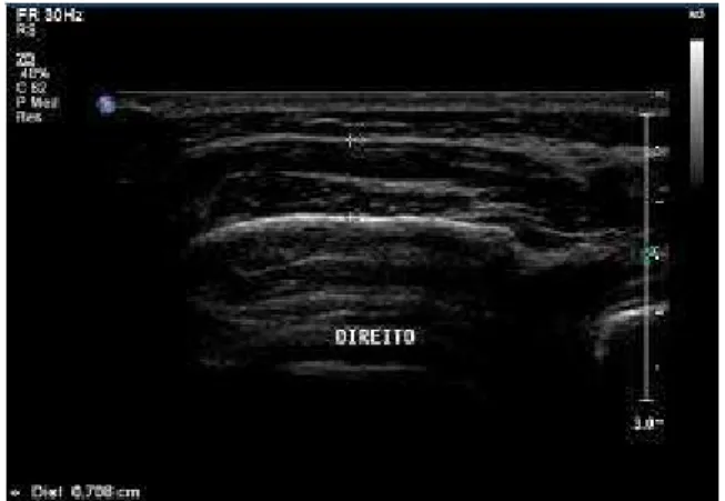 FIGURE 1. Ultrasonographic image of the rest condition (right masseter).