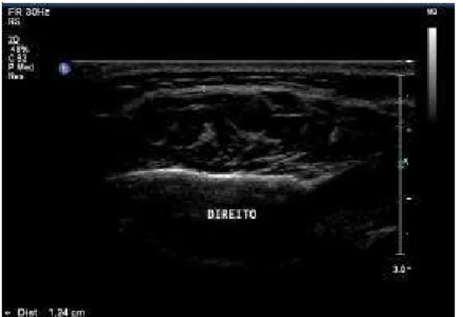 FIGURE 3. Ultrasonographic image during MIC (right masseter).