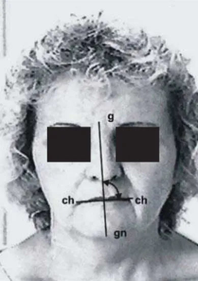 FIGURE 2. final assessment of person with left PFP (LCA=92o).