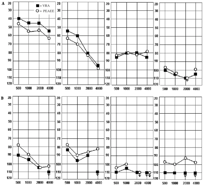 FIGURE 1. Examples of cases of comparison ASSR x VRA at the frequencies of 500 Hz, 1000 Hz, 2000 Hz and 4000 Hz.