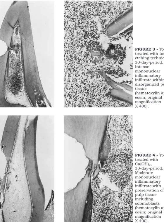 FIGURE 1 - Tooth treated with total etching technique, 7-day-period. Intense inflammatory infiltrate under exposure extending to the remaining pulp tissue (hematoxylin and eosin; original magnification X 40)