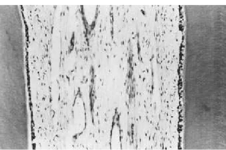 FIGURE 6 - Tooth treated with Ca(OH) 2 , 45-day-period.