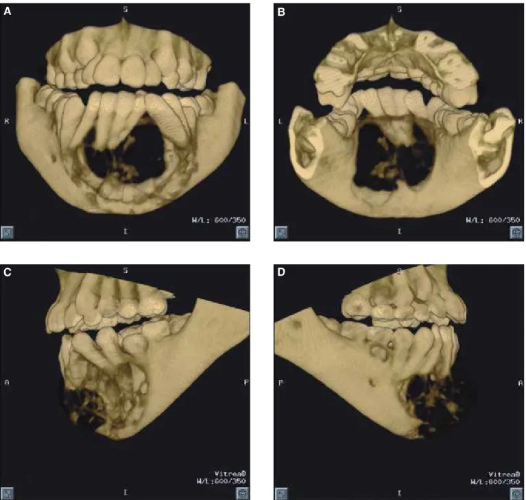 FIGURE 2 -  The 3D-CT bone pro to col shows the des truc ti on of bone ca u sed by the le si on and the as pect of the man di - -ble from the an te ri or (A), pos te ri or (B), left (C) and right (D) vi ews.