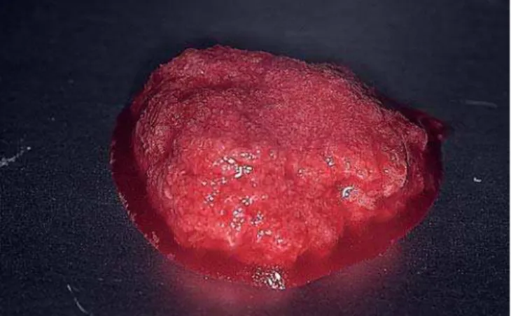 FIGURE 5 - The defect filled with autogenous bone from the collector. FIGURE 6 -Periapical X-rays weremade 6 to 8 months after installation ofthe implants.