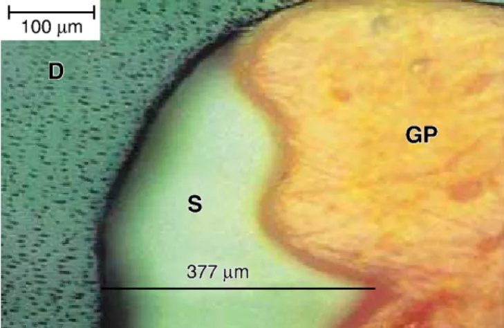 FIGURE 1 -  Cross-sec ti on of cervical third sho wing a thin la yer of se a ler (S), in in ter fa ce bet we en fil ling (GP) and den ti nal wall (D)