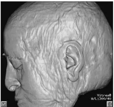 FIGURE 5 - 3D-CT la te ral view of a soft tis sue me a su re - -ment: Po-N (125.5 mm).