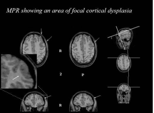 Figure 1. Example of multiplanar reformatting (MPR) showing area of focal cortical dysplasia (arrows).