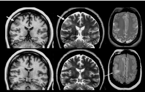 Figure 4. Coronal inversion recovery an T2 weighted, and axial T2 weighted and proton density MRI showing typical findings in focal cortical dysplasia (arrows): Cortical thickening and blurring of the gray-white matter junction, accompanied by focal gyral 