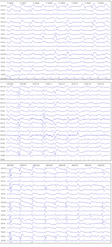 Figure 3. Periodic generalized triphasic wave complexes, moderate amplitude, at rest. Last EEG day-25.