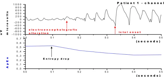 Figure 5. ECoG obtained from patient 1, channel 1. Above: ECoG  showing the beginning of epileptic activity