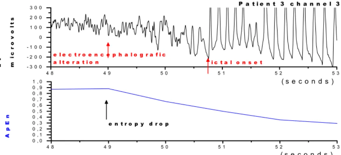 Figure 10. ECoG obtained from patient 3, channel 3. Above: ECoG  showing the beginning of epileptic activity