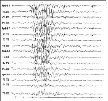 Figura 5. EEG realizado no segundo dia após início do tratamento mostrando pontas-ondas generalizadas