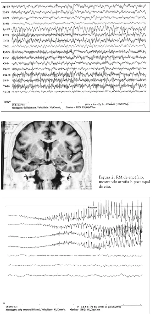 Figura 1. EEG de escalpo, registro ictal mostrando crise vindo da região temporal esquerda.