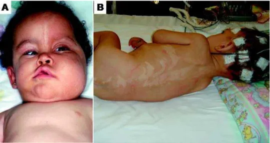 Figure 1. Syndromes associated with HME. A. A patient with epidermal nevus syndrome.