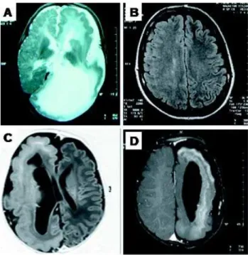 Figure 2. Magnetic resonance image in patients with HME.