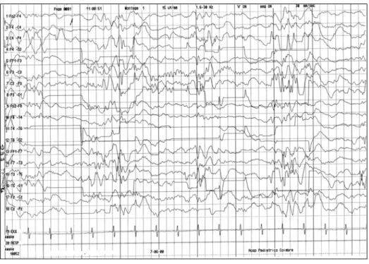 Figura 1. Primeiro EEG realizado, com padrao de hipsarritmia.