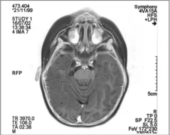Figura 3. EEG após primeira cirurgia, ainda com descargas no quadrante posterior.