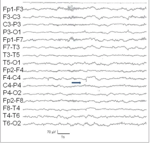 Figure 1. Sleep deprived EEG  showing sharp waves over the  right centroparietal area and less  frequently on the homologous left  region (patient 6).