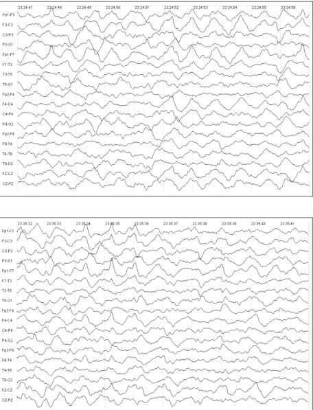 Figure 1. Electroencephalogram showing  slow background activity in patient with  seizure (clonias of the right arm and lateral  deviation of the eyes – patient 10).