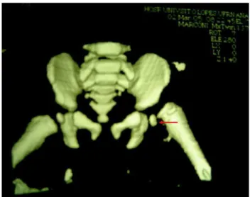 Figura  1.  Asymmetry  due  to  transepiphyseal  fracture  of  the  left  femoral  neck  observed  by  computerized  tomography