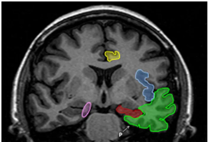 Figure 1. T1 weighted – IR (inversion recovery) coronal MRI. 