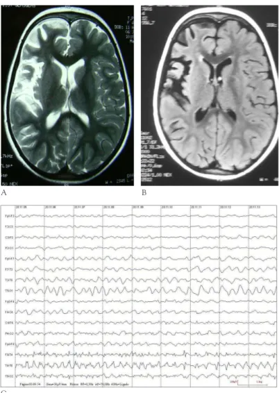 Figure 1. A) T2-weighted MRI imaging demonstrating atrophic changes in  the right hemisphere, more evident around the Sylvian fissure and insular  cortex