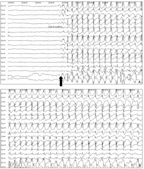 Figure 4. Thee year-old  patient with Early Onset  CAE. EEG during a typical  absence seizure