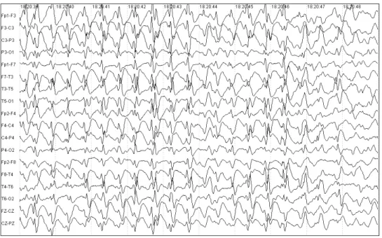 Figure 5. Eleven year-old  patient with atypical absence  epileptic status. EEG shows  generalized and irregular  slow (2Hz) spike-and-wave  complexes