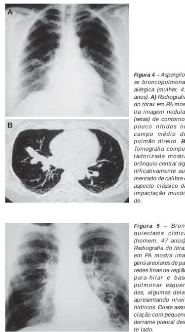 Figura 3  – Síndrome de Kartagener  (mu-lher, 41 anos).  Radio-grafia de tórax em PA mostra o “ situs  inver-sus” , com o ápi ce cardíaco e o botão aórtico à direita