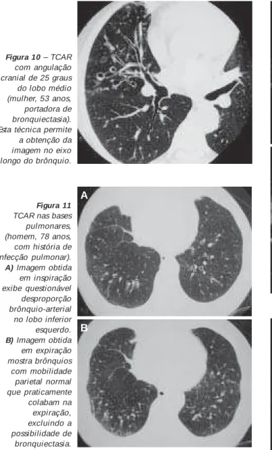 Figura 11 TCAR nas bases pulmonares, (homem, 78 anos, com história de infecção pulmonar)