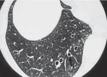 Figura 14 – TCAR na base pulmonar direita (mulher, 69 anos, com bronquiectasia cilíndrica)