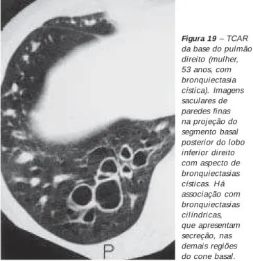 Figura 18 – TCAR no nível da artéria pulmonar direita (homem, 42 anos, portador de síndrome de William Campbell)