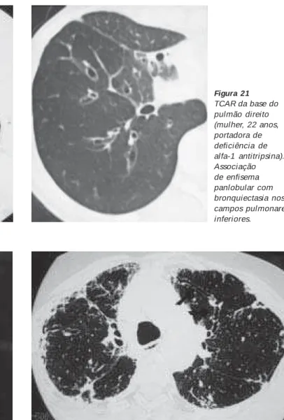 Figura 23 – TCAR ao nível da croça da aorta (mulher, 67 anos, porta- porta-dora de fibrose pulmonar intersticial)