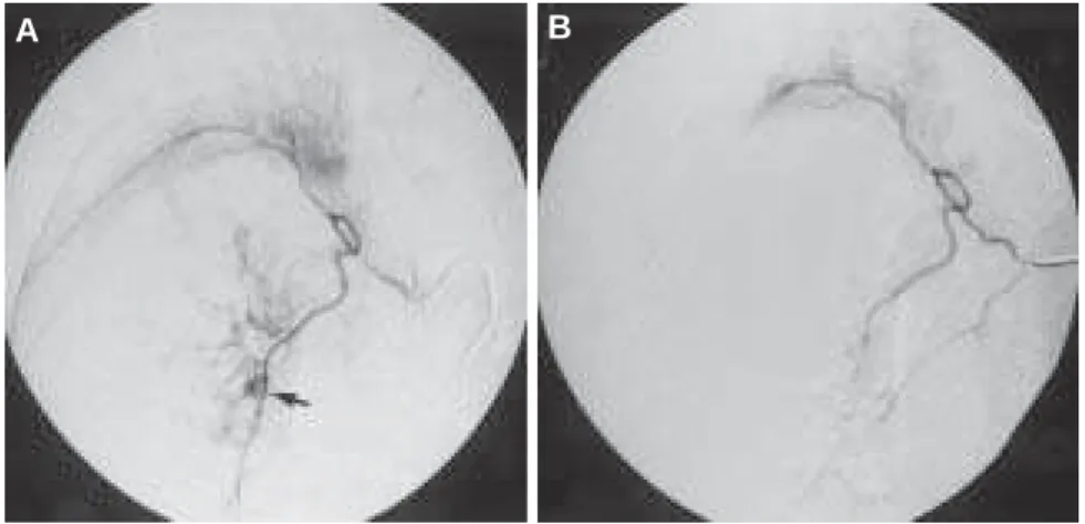 Figura 24 – Arteriografia brônquica seletiva à direita (homem, 68 anos, com hemoptise volumosa por bronquiectasia)