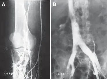 Figura 5 Radiografia simples do tórax em PA (homem com EP). As setas mostram aumento do ramo interlobar da artéria pulmonar esquerda.Figura 3 Embolia pulmonaraguda sem infarto(mulher, 50 anos).A) Radiografiasimples do tóraxem PA semanormalidades.B) Angiogr