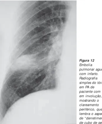 Figura 10 Embolia pulmonar aguda com infarto (homem, politraumatizado). A radiografia simples do tórax em PA mostra imagem lembrando edema