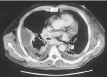 Figura 13 – Embo- Embo-lia pulmonar  agu-da com infarto  (ho-mem, 45 anos,  por-tador de  marcapas-so cardíaco)