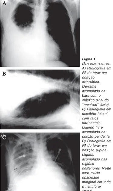 Figura 1 D ERRAME PLEURAL . A) Radiografia em PA do tórax em posição ortostática. Derrame acumulado na base com o clássico sinal do “ menisco”  (seta)